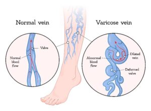 A diagram of a normal vein versus a varicose vein inside of a lower leg